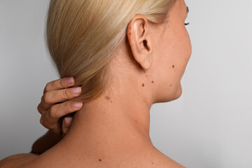 Woman with birthmarks on light grey background, back view