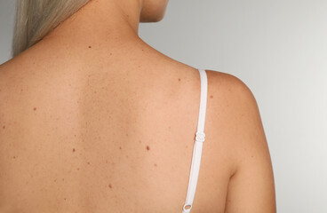 Closeup of woman`s body with birthmarks on light grey background, back view