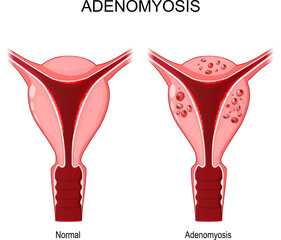 Adenomyosis. normal and unhealthy abnormal uterus.