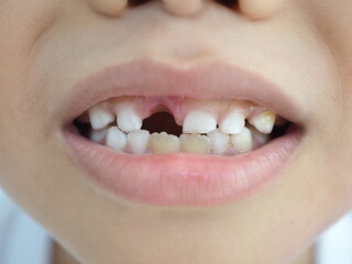 Kid patient open mouth showing cavities teeth decay. Caused by unclean brushing, eating candy....