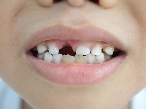 Kid patient open mouth showing cavities teeth decay. Caused by unclean brushing, eating candy. Concepts about oral health. closeup photo, blurred.