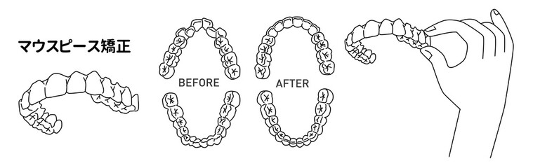 マウスピース矯正/インビザライン/矯正装置/aliner/orthodontic/mouth piece/invisalign