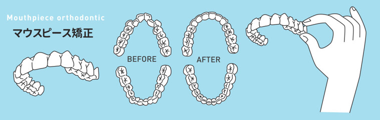 マウスピース矯正/インビザライン/矯正装置/aliner/orthodontic/mouth piece/invisalign