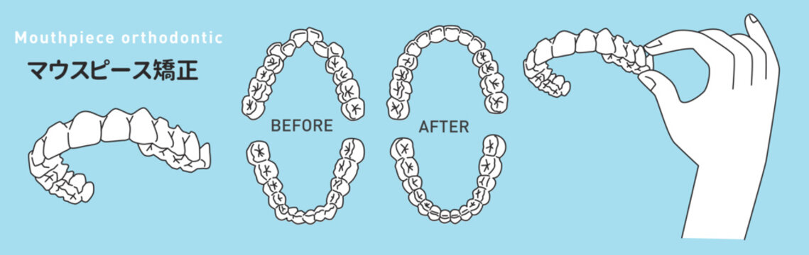 マウスピース矯正/インビザライン/矯正装置/aliner/orthodontic/mouth piece/invisalign