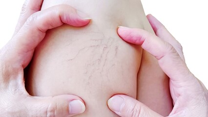 A woman has varicose veins on her thighs.