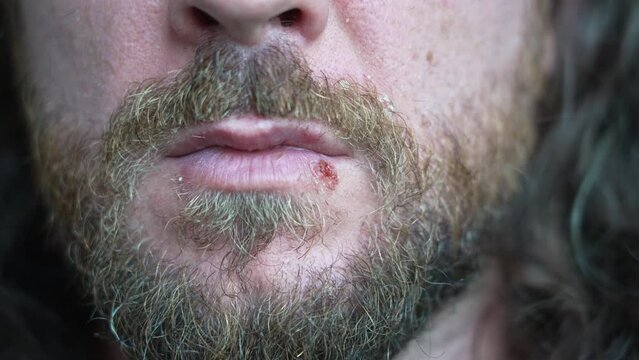 Seborrheic dermatitis and cold sores. Man with long beard shows dry skin and effects of the hepers simplex virus. Viral infections and skin diseases. Stress, itching and poor hydration.