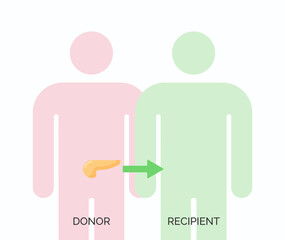 Human organ transplantation concept. Vector illustration of donor and recipient of pancreas organ