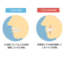歯の擦り減りとTCH　ストレス顎関節症.