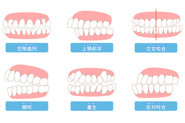 歯科矯正　歯並び　叢生、反対咬合、開咬、上顎前突、空隙歯列、すきっ歯. - obrazy, fototapety, plakaty