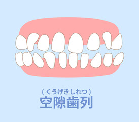 歯科矯正　歯並び　叢生、反対咬合、開咬、上顎前突、空隙歯列、すきっ歯. © sumaki