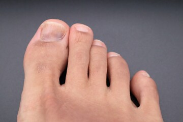怪我で爪が黒くなった足