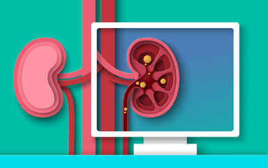 Kidney stones disease paper cut 3d vector