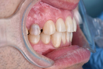 Close up teeth dentist dental problem examination before treatment tooth pain 