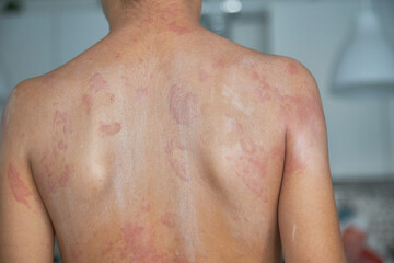 Fototapeta premium Itchy skin, dermatitis, food allergies. baby showing her back with acne, red spots. Baby's having itching, scratching her body with allergy rash..
