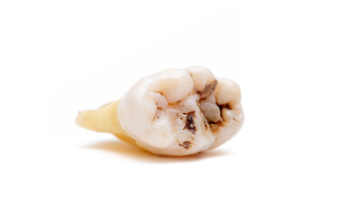 Close-up of a tooth with caries isolated on a white background. Removed wisdom teeth. Sick human teeth.