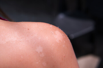 Fototapeta premium Sun tan on skin close up