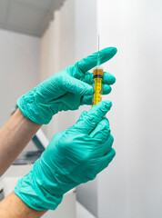 Platelet rich plasma preparation. Centrifuge experiment plasma in syringe.