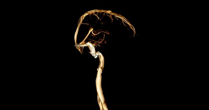 CTV Brain scan 3D rendering for diagnosis cavernous sinus thrombosis.