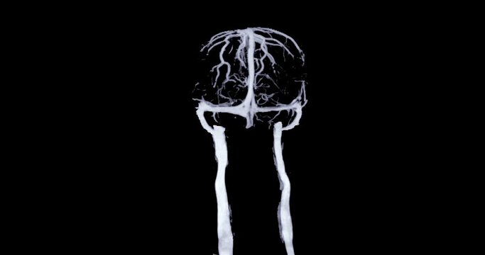 CTV Brain scan 3D rendering for diagnosis cavernous sinus thrombosis.