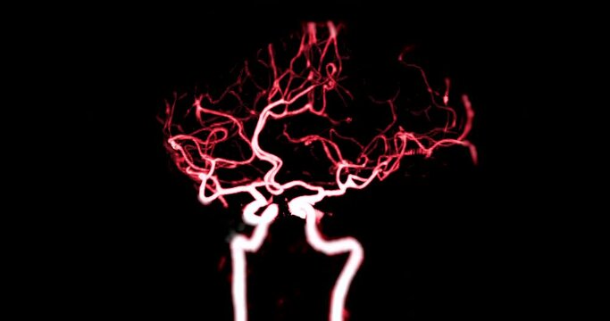 CTA  Brain or Computed tomographic angiography of cerebral artery 2D image for diagnosis cerebral artery aneurysm and stroke diseases