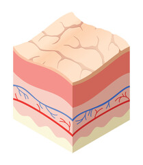 Skincare medical concept. Problems in cross-section of human skin horizontal layers structure. Anatomy illustrative model unhealthly layer of skin - obrazy, fototapety, plakaty