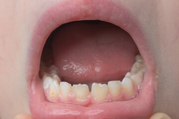 Obraz premium Jaw with children's straight teeth close-up.