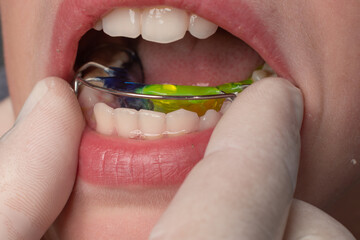 The orthodontist puts a plate on the lower teeth, a visit to the orthodontist. © Niko_Dali
