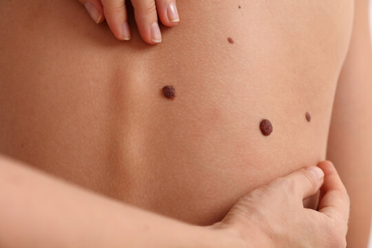 Doctor dermatologist examines patient birthmarks close up. Prevention concept
