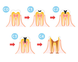 虫歯と進行と治療:歯科のイラスト