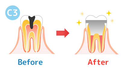 虫歯と進行C1-C4と治療:歯科のイラスト