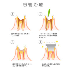 根管治療 虫歯と進行と治療:歯科のイラスト