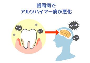 Fototapeta premium 歯周病とアルツハイマー病の関係.