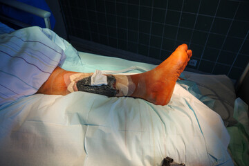 an open wound is treated in a hospital with vacuum therapy