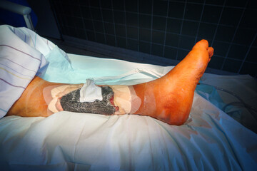 an open wound is treated in a hospital with vacuum therapy