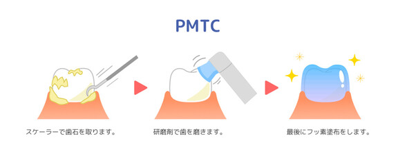PMTC 歯のクリーニング:歯科イラスト.