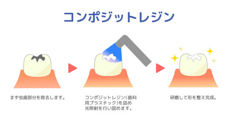 コンポジットレジンCR接着修復法のイラスト.