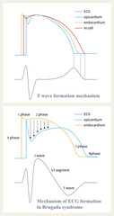 Obraz premium The mechanism of Brugada syndrome is the difference of repolarization phase 1 and phase 2 between epicardium and endocardium, and the loss of epicardial plateau leads to ST segment elevation.