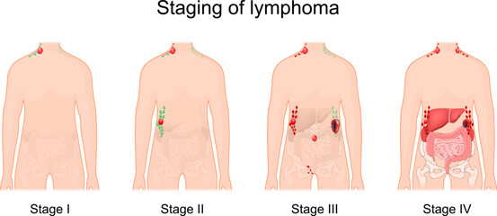 lymphoma stage. Cancer of the lymphatic system.