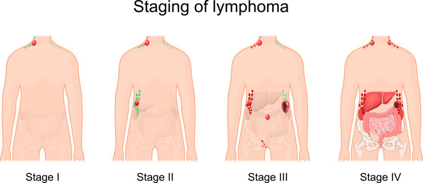 lymphoma stage. Cancer of the lymphatic system.