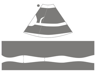 Diagram of Inferior Vena Cava Ultrasound in M Mode