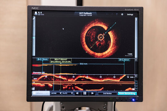 Istanbul, Turkey - September 20, 2022 ; Optical coherence tomography (OCT) was performed measurement of coronary artery in cross-sectional and longitudinal view.