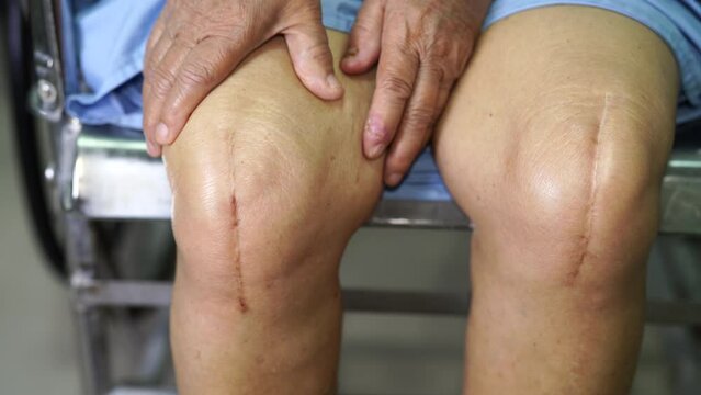Asian senior or elderly old lady woman patient show her scars surgical total knee joint replacement Suture wound surgery arthroplasty on bed in nursing hospital ward, healthy strong medical concept.