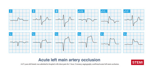 Acute left main artery occlusion can cause both ST segment elevation and non ST segment elevation myocardial infarction, regardless of which type, the risk of death is high.