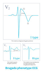 Only type 1 Brugada phenotype ECGs can directly diagnose Brugada syndrome, an inherited cardiac ion channel disorder associated with risk of sudden death.