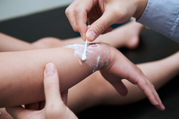 burn wound at arm apply by cream treatment