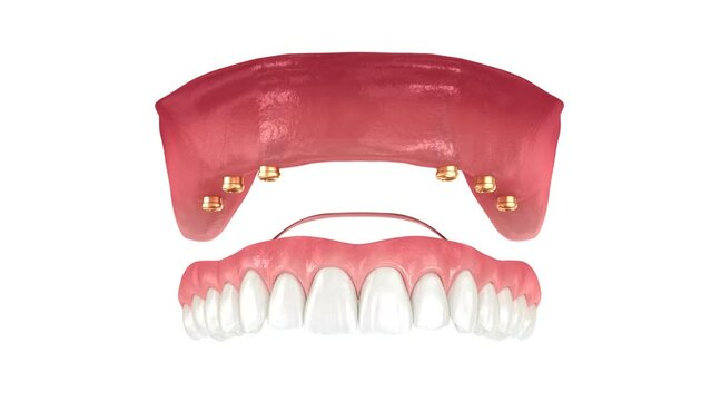 Removable prosthesis with gum All on 6 system supported by implants. Dental 3D animation