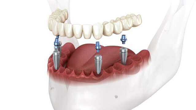 Mandibular prosthesis all on 4 system supported by implants. Medically accurate 3D animation