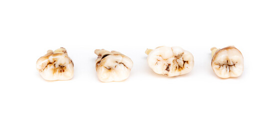 Set of teeth with caries on a white background. Wisdom teeth removed. Sick human teeth.