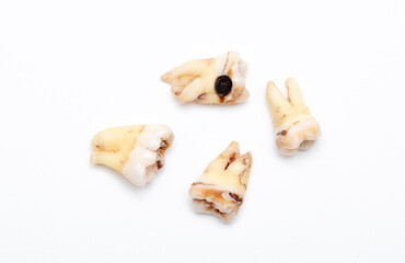 Set of teeth with caries on a white background. Wisdom teeth removed. Sick human teeth.