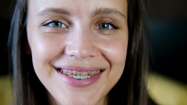 Beautiful smiling girl with brackets for teeth. Smiling woman. Female smile with dental braces close up. Braces Mouth